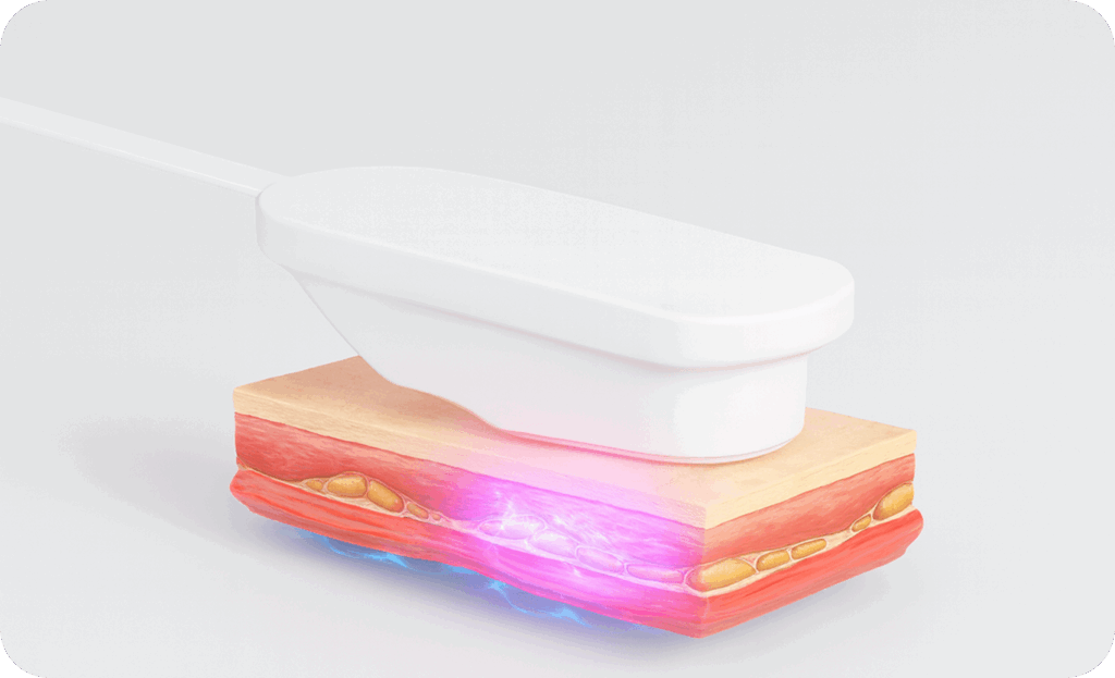 Illustration of a device applying energy to skin layers showing lifting or tightening effect