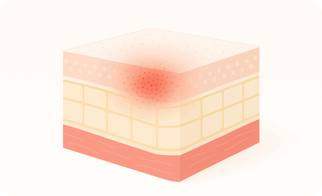 Diagram of skin layers showing melanin pigment distribution and cellular inflammation.