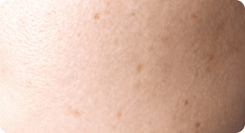 Diagram of aging skin with deep pigmentation, freckles, and sun spots before treatment.