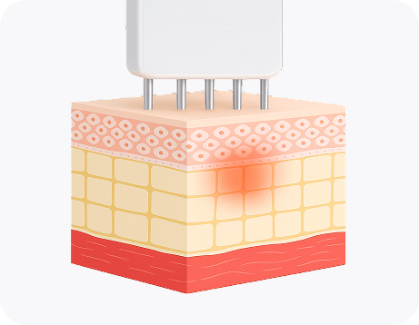 Potenza RF energy transmission deep into the dermis to stimulate collagen and elastin production.