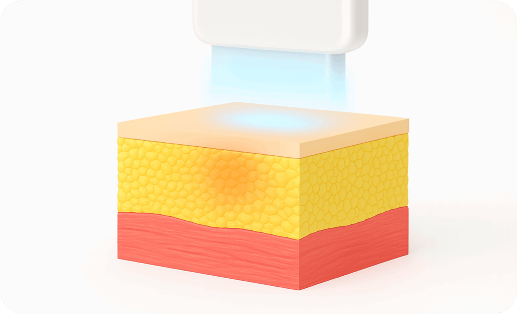 Close-up illustration of a skincare treatment device emitting energy into layered skin structure