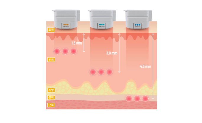 Depth-controlled energy delivery diagram showing 1.5 mm, 3.0 mm, and 4.5 mm penetration into skin layers