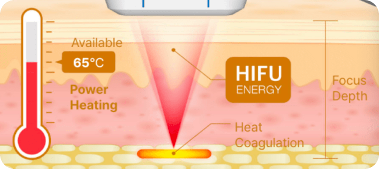HIFU energy penetration diagram showing focused heat coagulation at skin depth