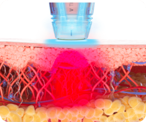 RF energy penetration into skin showing deep thermal stimulation